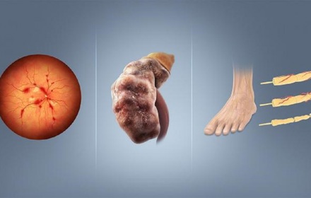 Diabetes Complications