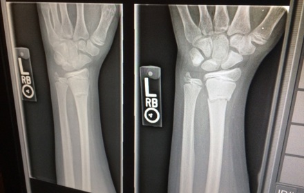 Bone Density